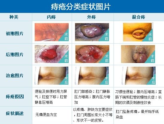 如何治疗好痔疮 痔疮药膏怎么样 