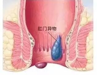 肛门异物由哪些疾病引起的？